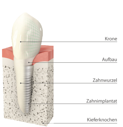 Aufbau eines Implantates - All-on-4® Günzburg – Feste Zähne an einem Tag